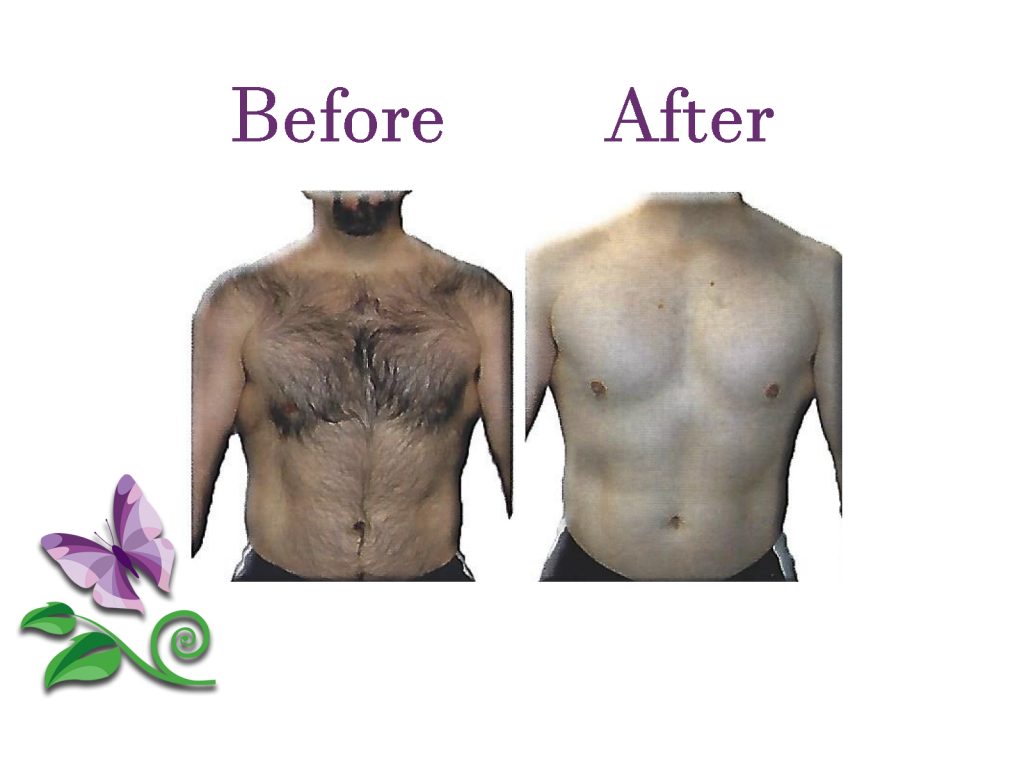 Permanent Hair Removal Chest