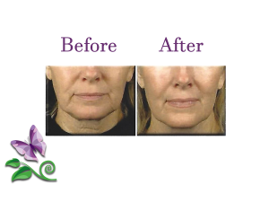 Non Surgical Face Lift