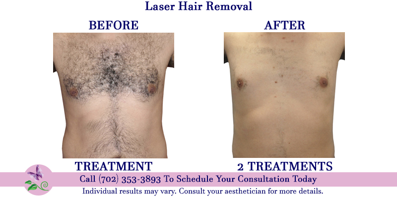 Laser Hair Removal - Shannon's Serendipity Skincare | Las Vegas